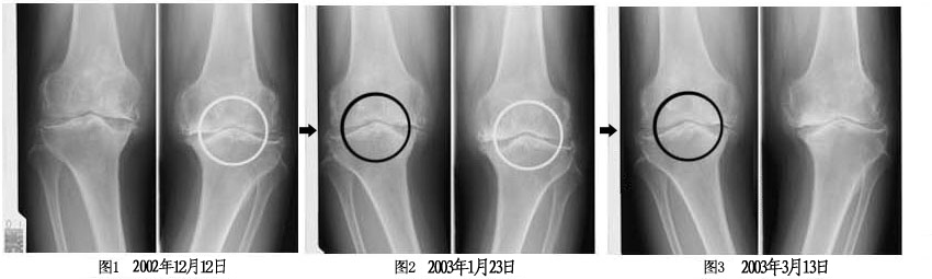 通过X光片判断软骨再生