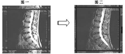 通过核磁共振观察到腰椎间盘突出减轻了（图）